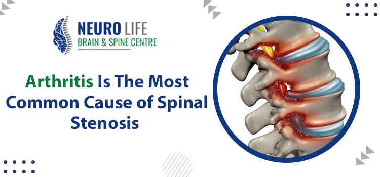 Arthritis Is The Most Common Cause of Spinal Stenosis