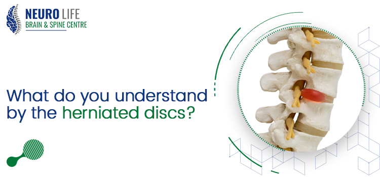 What do you understand by the herniated discs