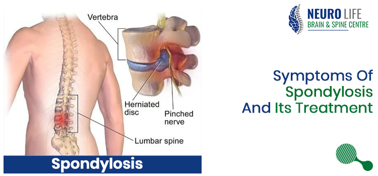 Spondylosis And Its Treatment