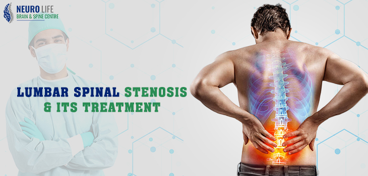 What Is Lumbar Spinal Stenosis, Its Causes, Symptoms, And Treatment?
