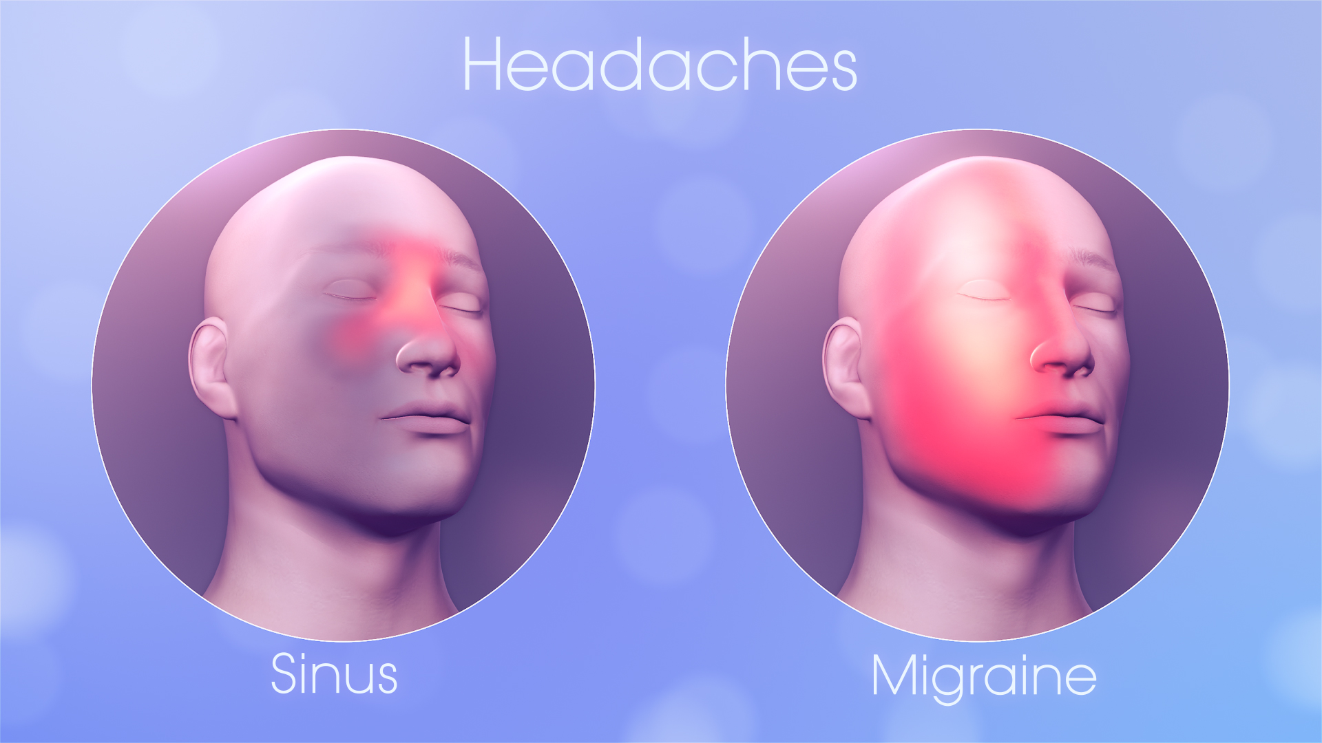क्या आपको माइग्रेन और साइनस सिरदर्द में फर्क लगता है ?